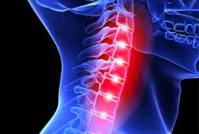 cervikalna osteohondroza liječenje boli u ramenu bol u koljenu i dislociranje