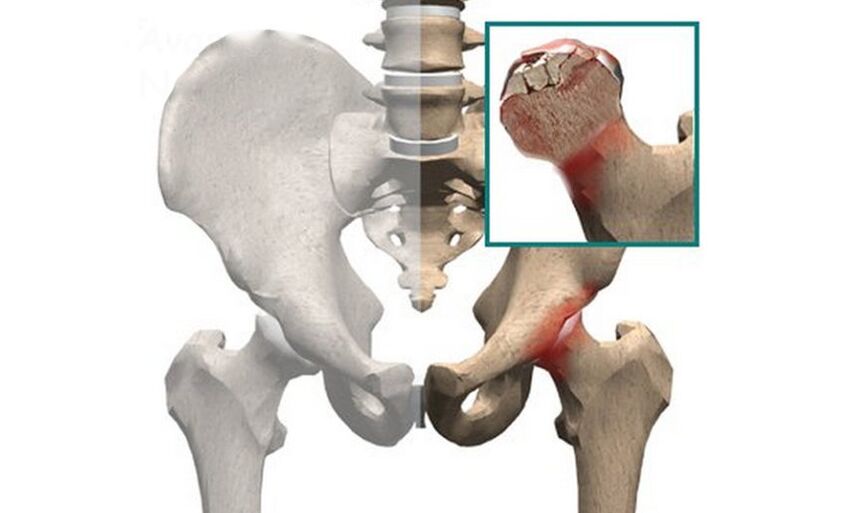 Nekroza glave bedrene kosti jedan je od uzroka boli u zglobu kuka