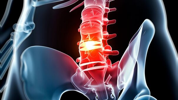 osteohondroza lumbalne kralježnice
